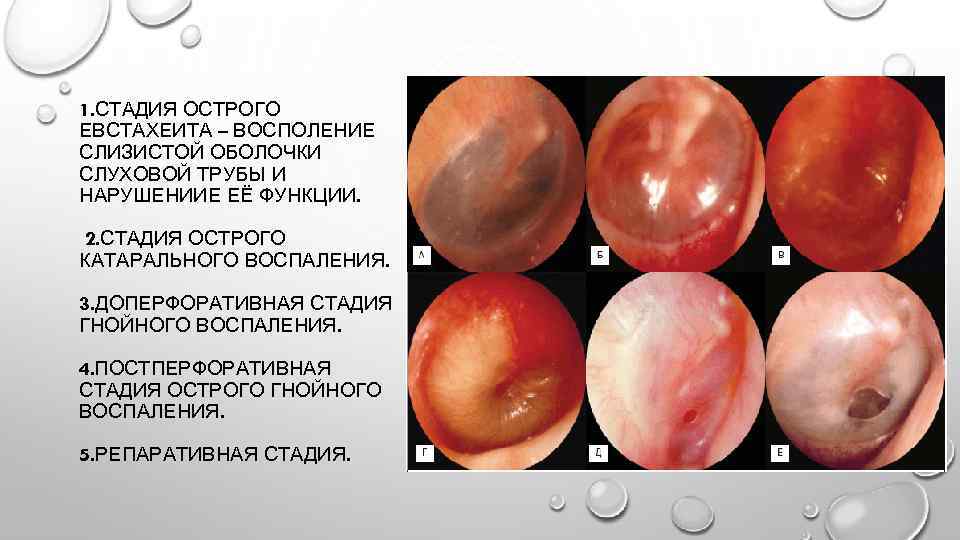 1. СТАДИЯ ОСТРОГО ЕВСТАХЕИТА – ВОСПОЛЕНИЕ СЛИЗИСТОЙ ОБОЛОЧКИ СЛУХОВОЙ ТРУБЫ И НАРУШЕНИИЕ ЕЁ ФУНКЦИИ.