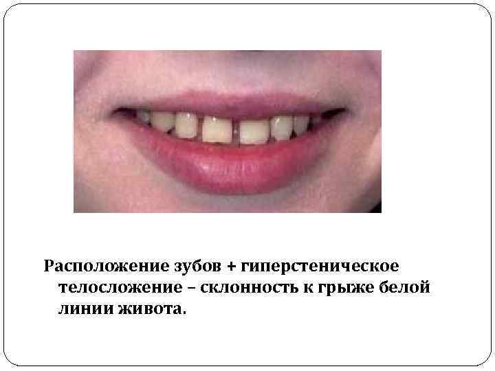 Расположение зубов + гиперстеническое телосложение – склонность к грыже белой линии живота. 