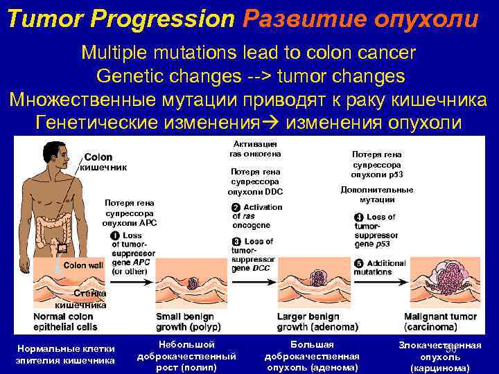 Tumor Progression Развитие опухоли Multiple mutations lead to colon cancer Genetic changes --> tumor