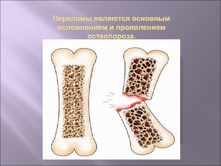 Переломы являются основным осложнением и проявлением остеопороза. 