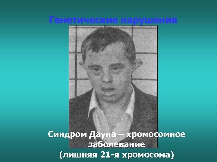Генетические нарушения Синдром Дауна – хромосомное заболевание (лишняя 21 -я хромосома) 