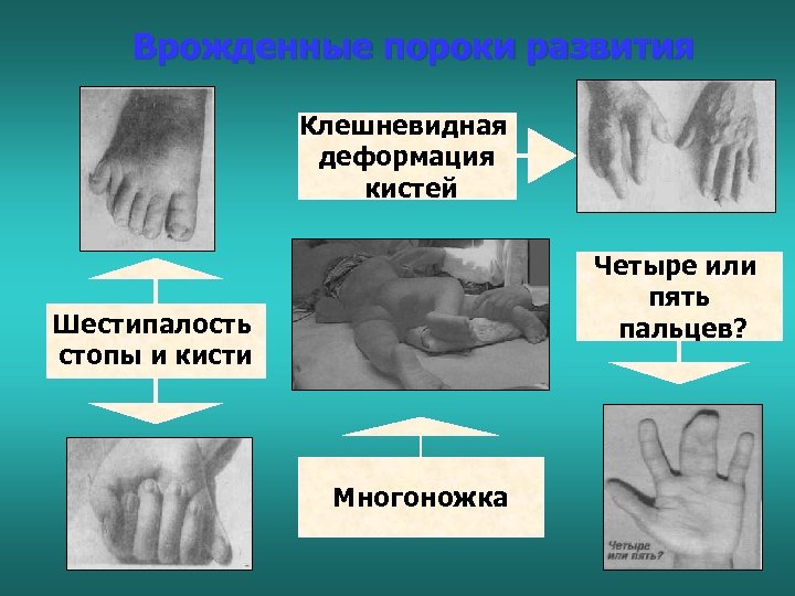 Врожденные пороки развития Клешневидная деформация кистей Четыре или пять пальцев? Шестипалость стопы и кисти
