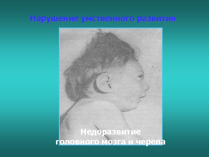 Нарушение умственного развития Недоразвитие головного мозга и черепа 