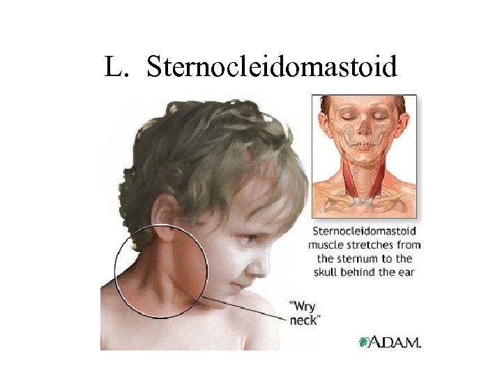 L. Sternocleidomastoid 