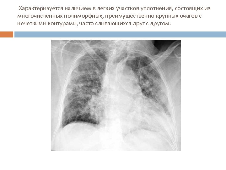  Характеризуется наличием в легких участков уплотнения, состоящих из многочисленных полиморфных, преимущественно крупных очагов
