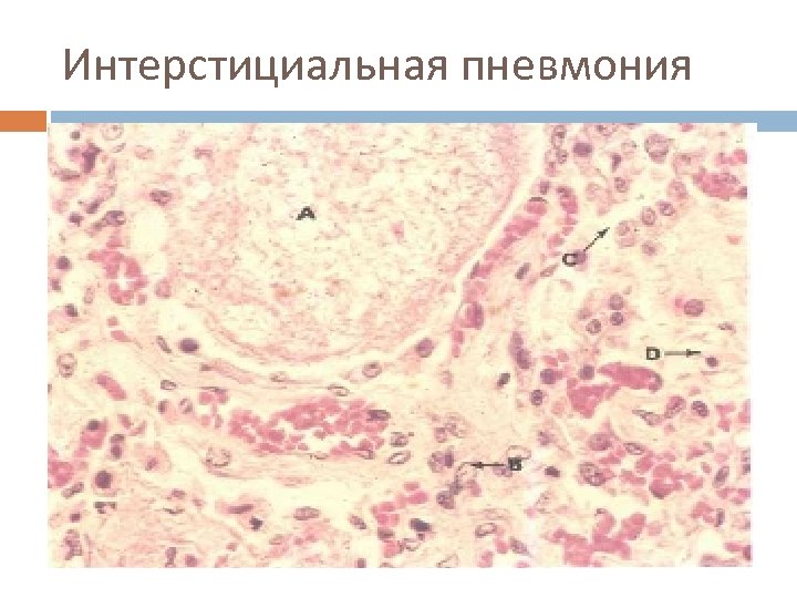 Интерстициальная пневмония 