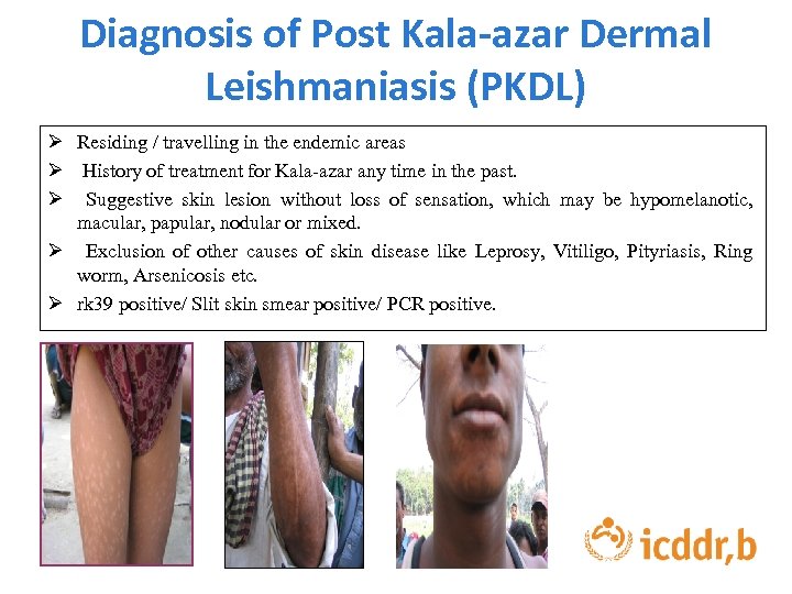 Diagnosis of Post Kala-azar Dermal Leishmaniasis (PKDL) Ø Residing / travelling in the endemic