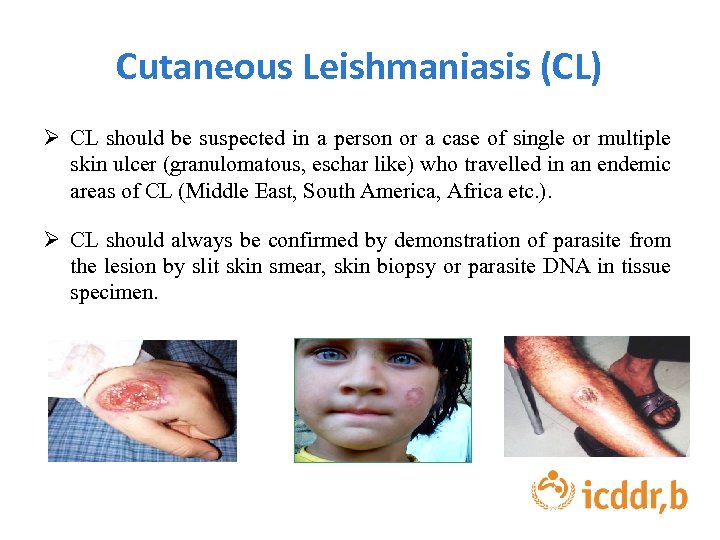 Cutaneous Leishmaniasis (CL) Ø CL should be suspected in a person or a case