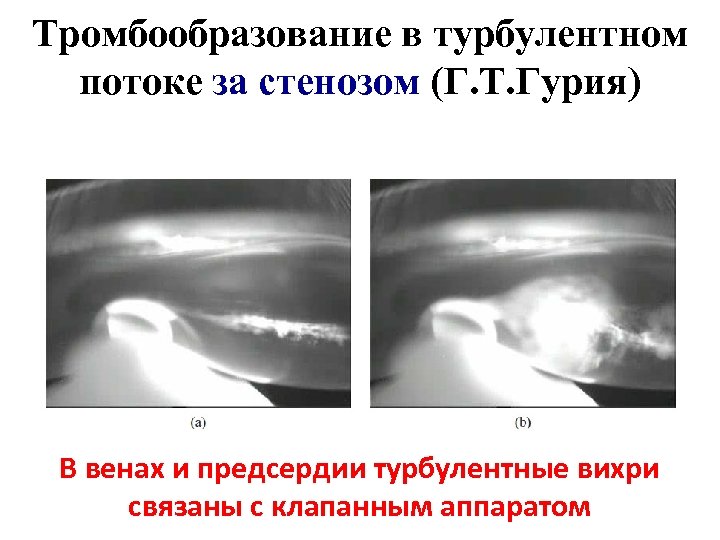 Тромбообразование в турбулентном потоке за стенозом (Г. Т. Гурия) В венах и предсердии турбулентные
