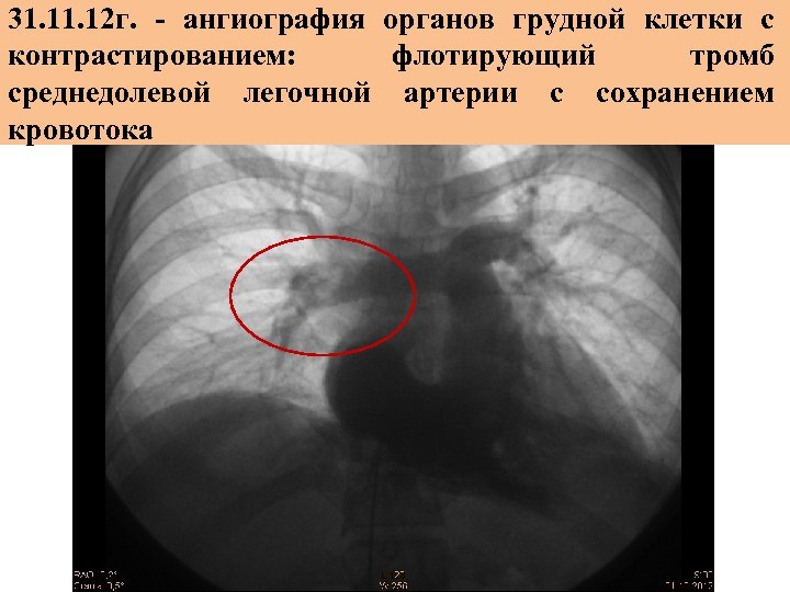 31. 12 г. - ангиография органов грудной клетки с контрастированием: флотирующий тромб среднедолевой легочной
