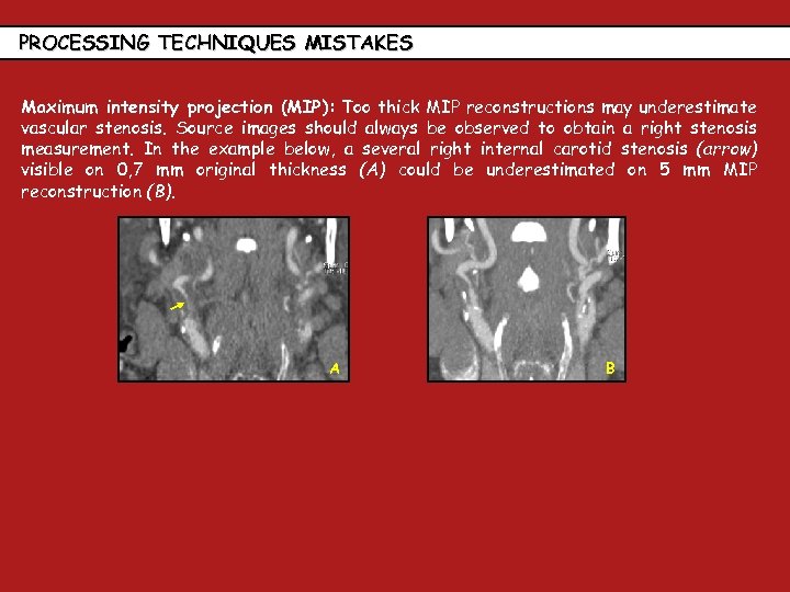 PROCESSING TECHNIQUES MISTAKES Maximum intensity projection (MIP): Too thick MIP reconstructions may underestimate vascular