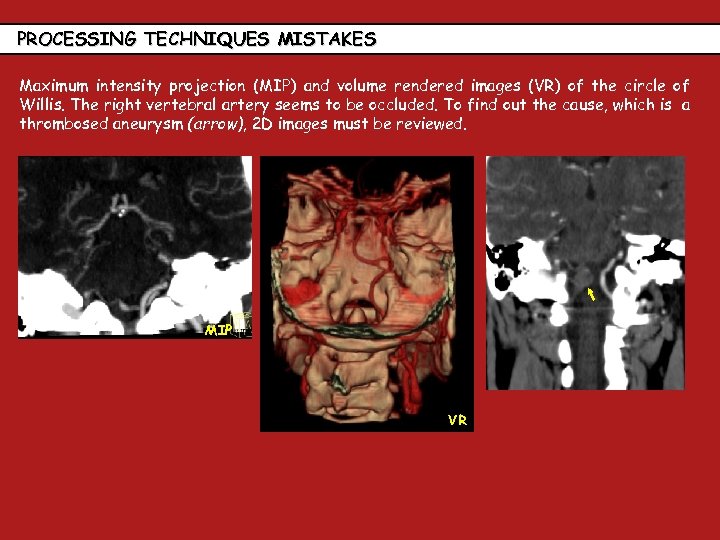 PROCESSING TECHNIQUES MISTAKES Maximum intensity projection (MIP) and volume rendered images (VR) of the