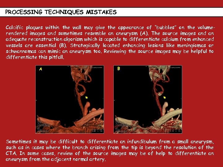 PROCESSING TECHNIQUES MISTAKES Calcific plaques within the wall may give the appearance of “bubbles”