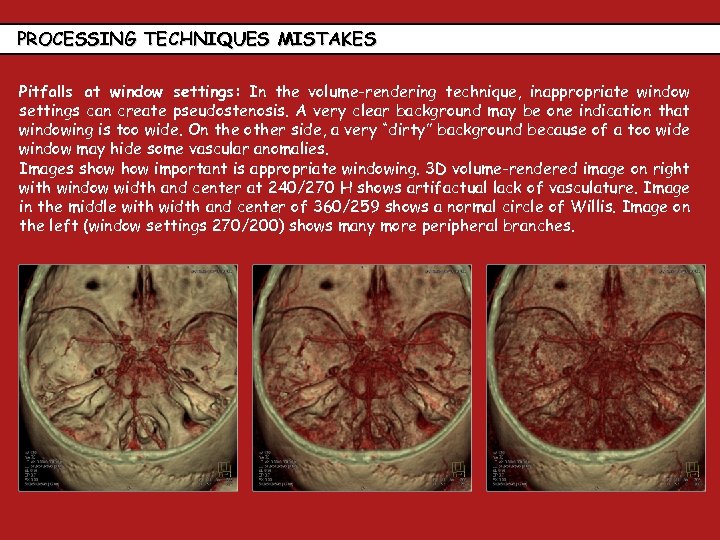PROCESSING TECHNIQUES MISTAKES Pitfalls at window settings: In the volume-rendering technique, inappropriate window settings
