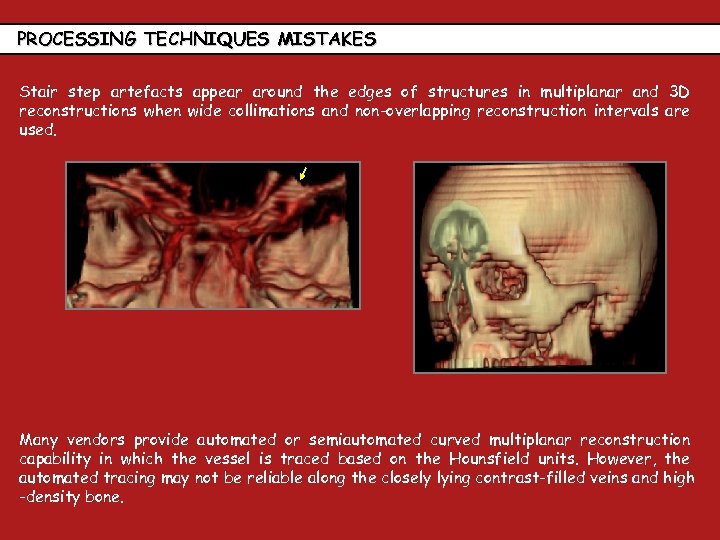 PROCESSING TECHNIQUES MISTAKES Stair step artefacts appear around the edges of structures in multiplanar