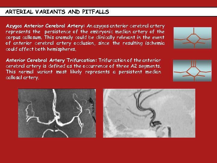 ARTERIAL VARIANTS AND PITFALLS Azygos Anterior Cerebral Artery: An azygos anterior cerebral artery represents