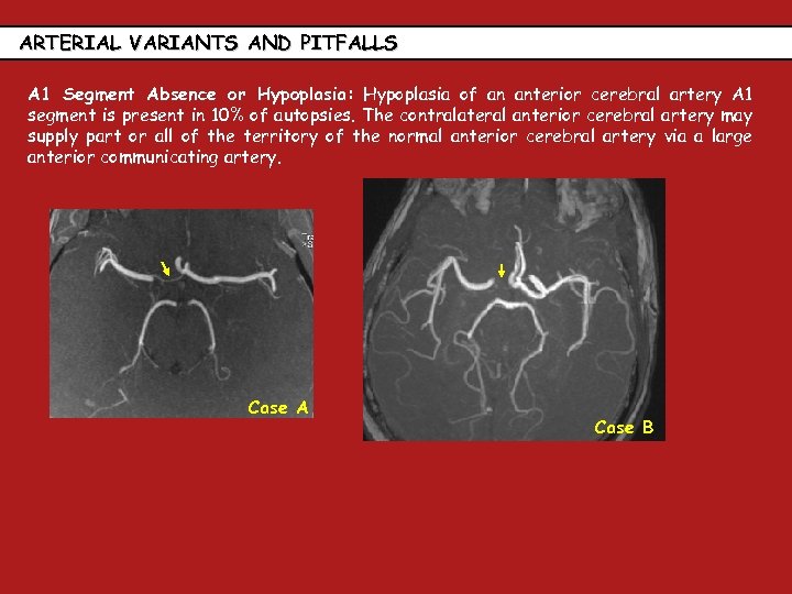 ARTERIAL VARIANTS AND PITFALLS A 1 Segment Absence or Hypoplasia: Hypoplasia of an anterior