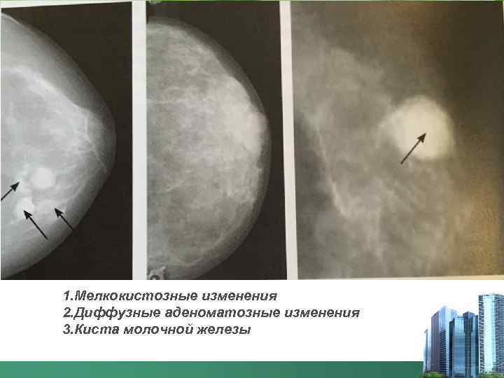 1. Мелкокистозные изменения 2. Диффузные аденоматозные изменения 3. Киста молочной железы 