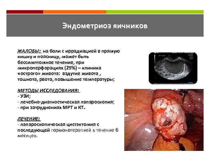 Эндометриоз яичников ЖАЛОБЫ: на боли с иррадиацией в прямую кишку и поясницу, может быть