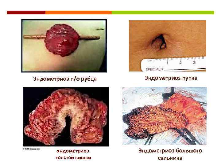 Эндометриоз п/о рубца Эндометриоз толстой кишки Эндометриоз пупка Эндометриоз большого сальника 