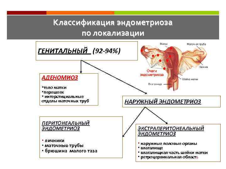 Классификация эндометриоза по локализации ГЕНИТАЛЬНЫЙ (92 -94%) АДЕНОМИОЗ • тело матки • перешеек •