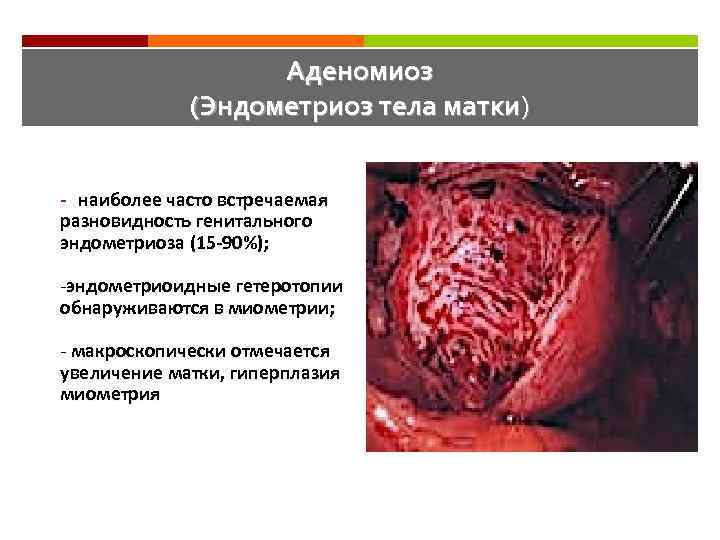 Аденомиоз (Эндометриоз тела матки) - наиболее часто встречаемая разновидность генитального эндометриоза (15 -90%); -эндометриоидные