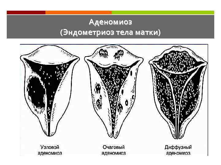 Аденомиоз (Эндометриоз тела матки) 