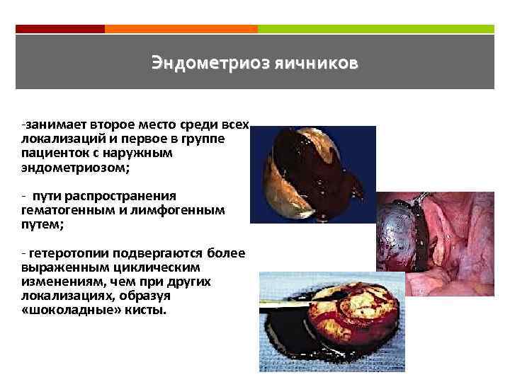 Эндометриоз яичников -занимает второе место среди всех локализаций и первое в группе пациенток с