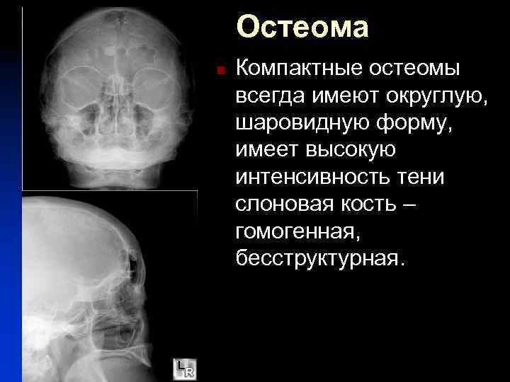 Остеома n Компактные остеомы всегда имеют округлую, шаровидную форму, имеет высокую интенсивность тени слоновая