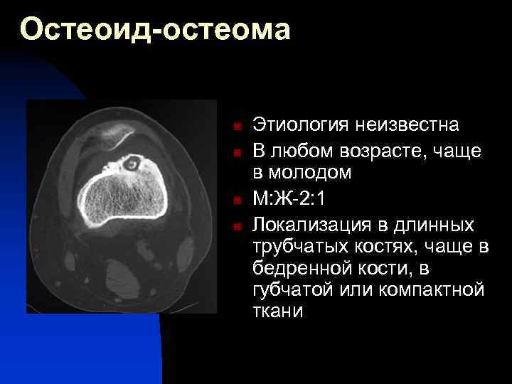 Остеоид остеома бедренной кости. Остеоид остеома черепа кт. Компактная остеома кости кт. Остеома бедренной кости мрт. Остеоид-остеома бедренной кости кт.