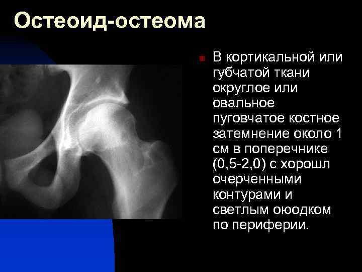 Остеоид-остеома n В кортикальной или губчатой ткани округлое или овальное пуговчатое костное затемнение около