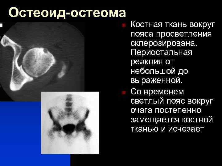 Остеоид-остеома n n Костная ткань вокруг пояса просветления склерозирована. Периостальная реакция от небольшой до