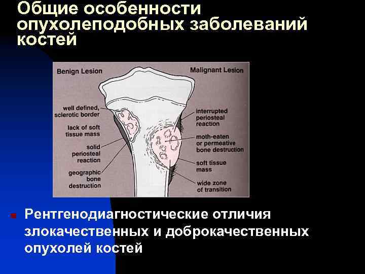 Доброкачественные и злокачественные опухоли костей