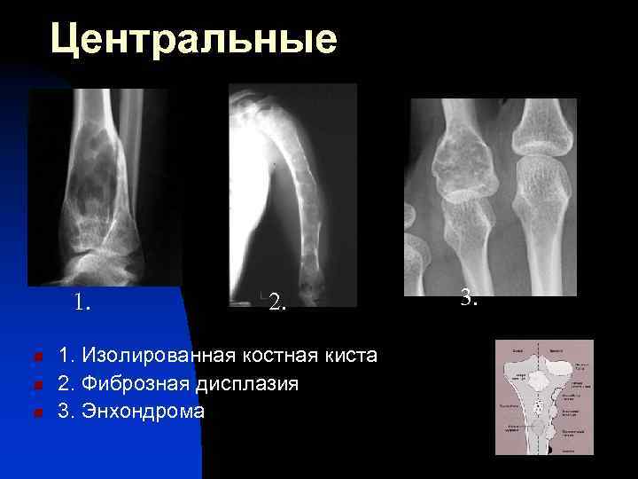 Дисплазия костей. Энхондрома лучевой кости. Энхондрома костей рентген. Фиброзная дисплазия плечевой кости кт. Фиброзная дисплазия большеберцовой кости кт.