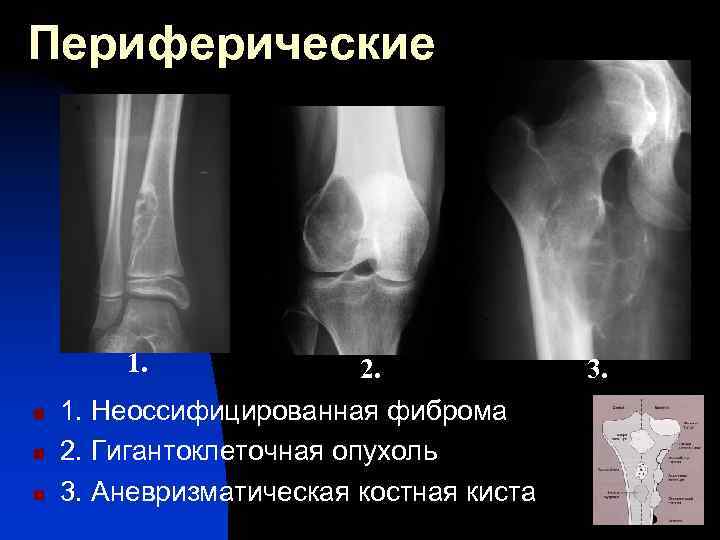 Рентгенологическая картина гигантоклеточной опухоли характеризуется разновидностями