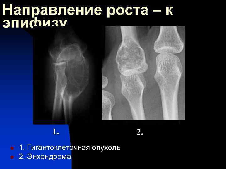 Опухоли лучевой кости. Гигантоклеточная опухоль большеберцовой кости. Фиброзная дисплазия лучевой кости. Энхондрома бедренной кости кт. Гигантоклеточная опухоль бедренной кости рентген.