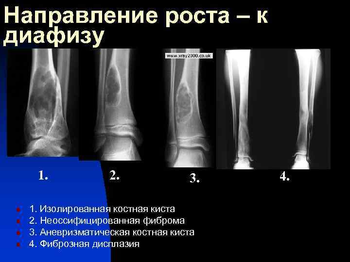 Фиброзная дисплазия большеберцовой кости