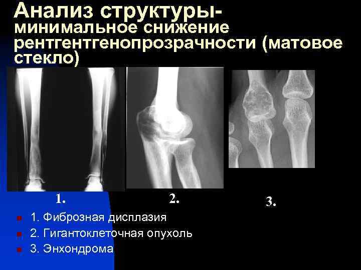 Анализ структуры- минимальное снижение рентгенопрозрачности (матовое стекло) 1. n n n 2. 1. Фиброзная