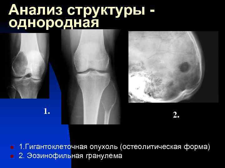 Рентгенологическая картина гигантоклеточной опухоли характеризуется разновидностями