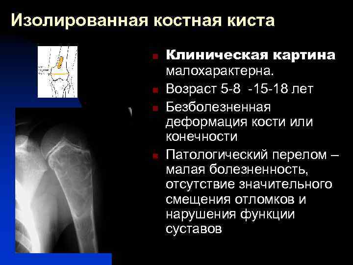 Изолированная костная киста n n Клиническая картина малохарактерна. Возраст 5 -8 -15 -18 лет
