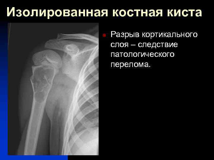 Изолированная костная киста n Разрыв кортикального слоя – следствие патологического перелома. 