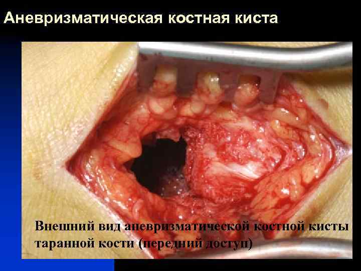 Аневризматическая костная киста Внешний вид аневризматической костной кисты таранной кости (передний доступ) 