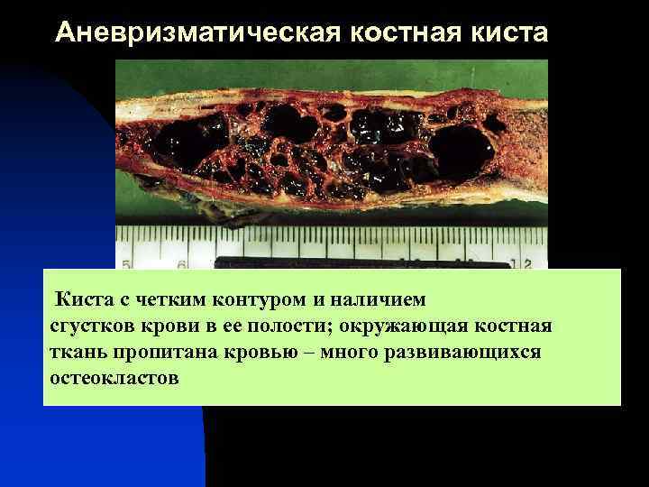 Аневризматическая костная киста Киста с четким контуром и наличием сгустков крови в ее полости;