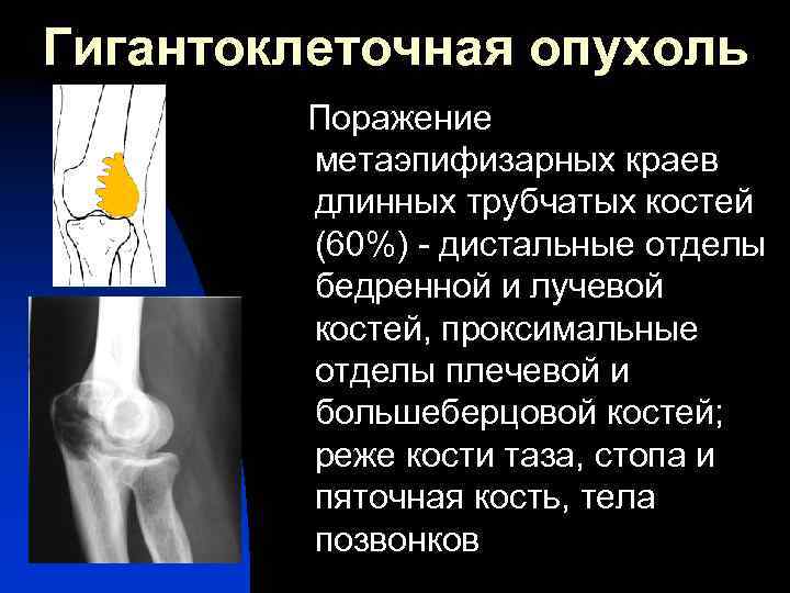 Гигантоклеточная опухоль Поражение метаэпифизарных краев длинных трубчатых костей (60%) - дистальные отделы бедренной и