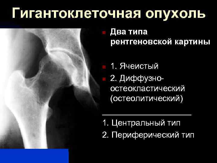 Рентгенологическая картина гигантоклеточной опухоли характеризуется разновидностями