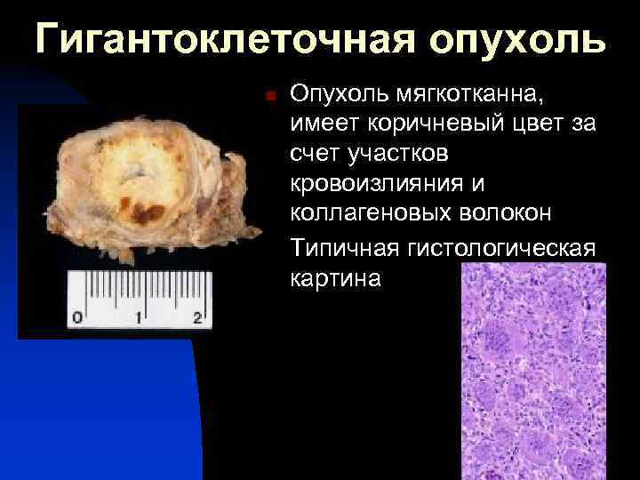 Гигантоклеточная опухоль n n Опухоль мягкотканна, имеет коричневый цвет за счет участков кровоизлияния и