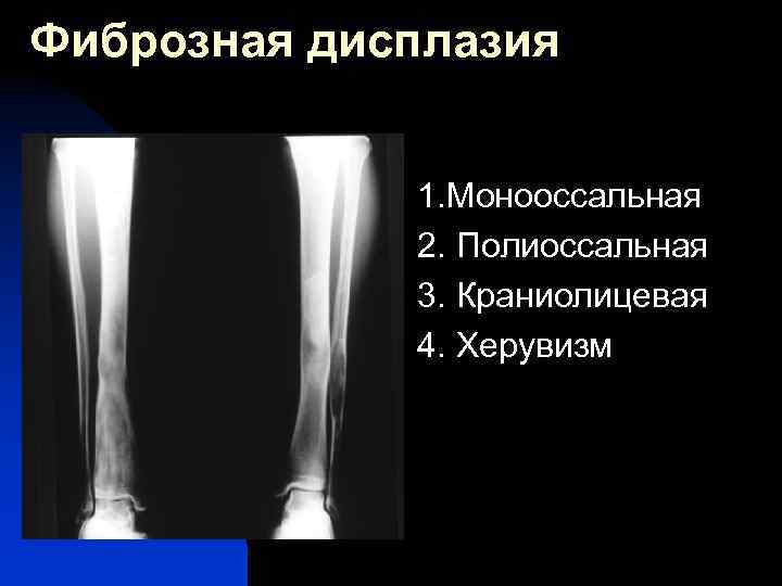 Фиброзная дисплазия 1. Монооссальная 2. Полиоссальная 3. Краниолицевая 4. Херувизм 