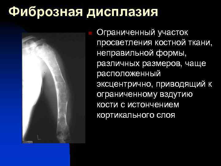 Фиброзная дисплазия n Ограниченный участок просветления костной ткани, неправильной формы, различных размеров, чаще расположенный