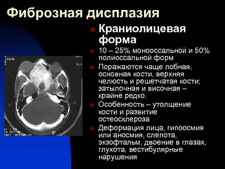 Дисплазия костей. Фиброзная дисплазия основной кости. Фиброзная дисплазия лобной кости кт. Фиброзная дисплазия клиновидной кости на кт. Фиброзная дисплазия костей черепа.