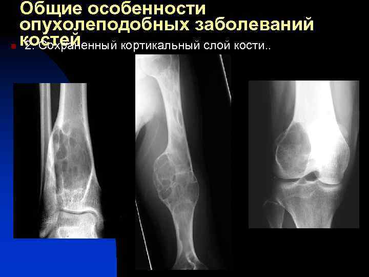 Общие особенности опухолеподобных заболеваний n костей 2. Сохраненный кортикальный слой кости. . 